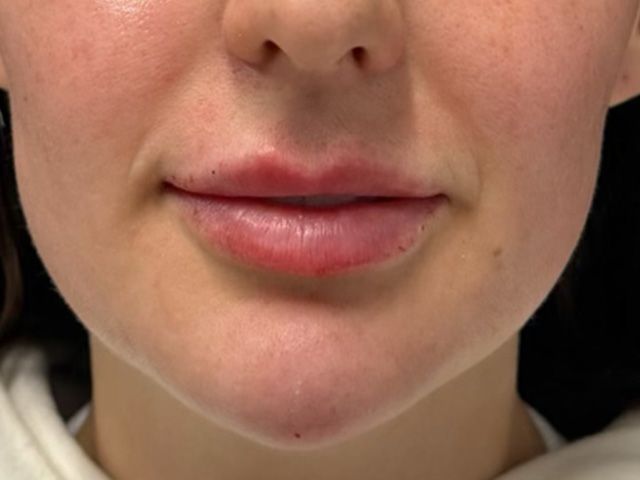 Lower Face Before & After