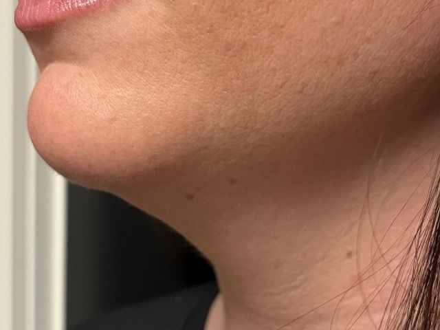 Lower Face Before & After