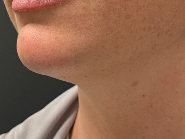 Lower Face Before & After