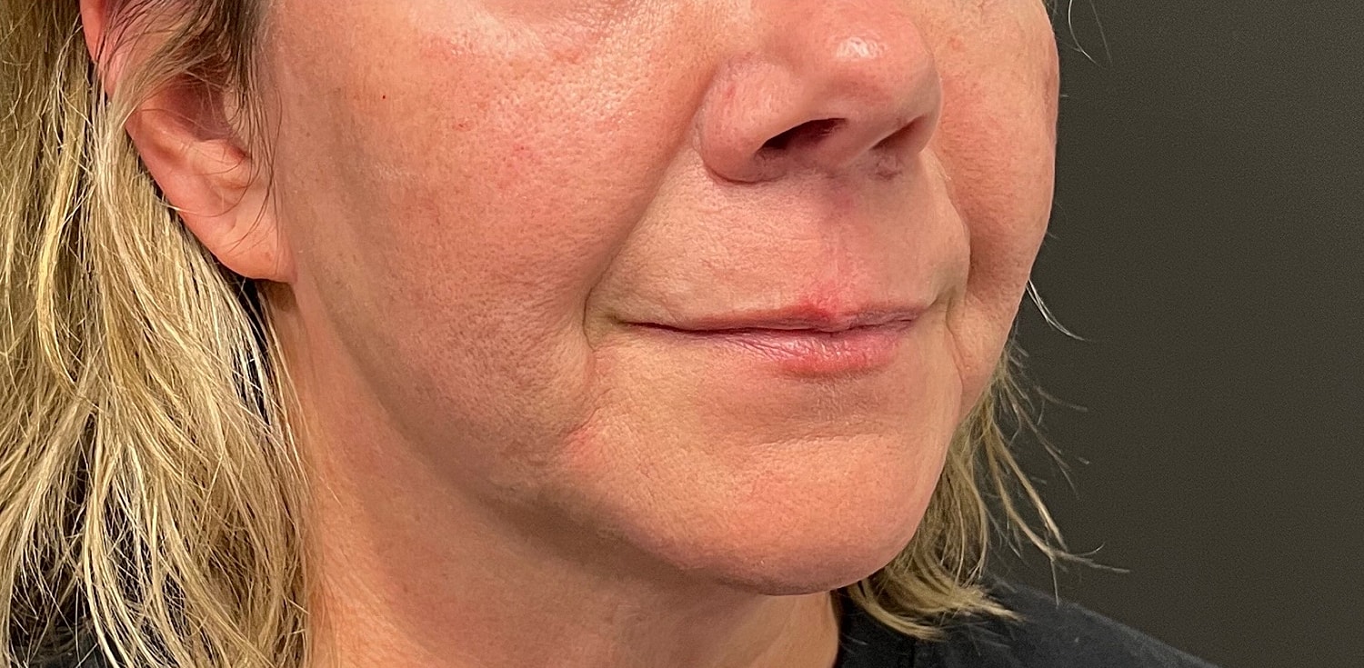 Lower Face Before & After