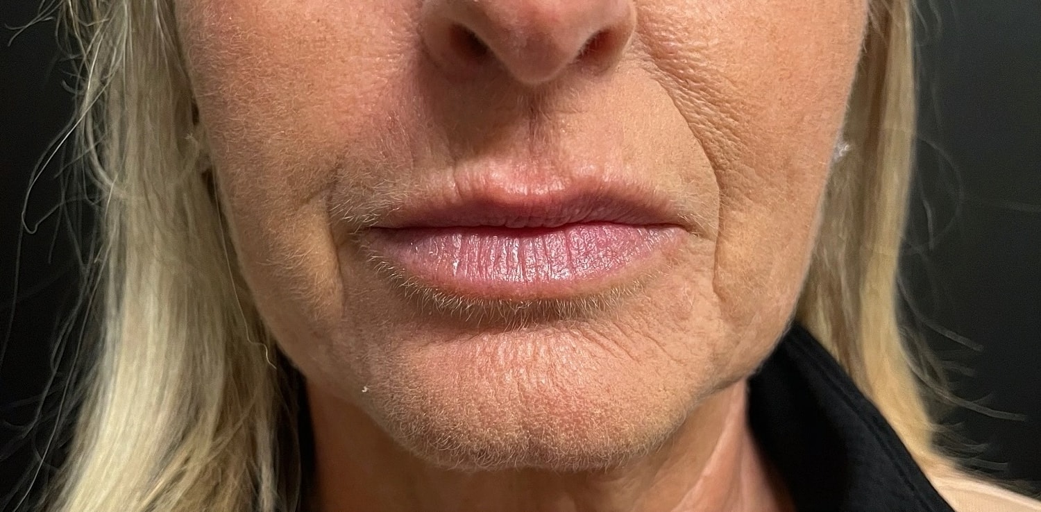 Lower Face Before & After
