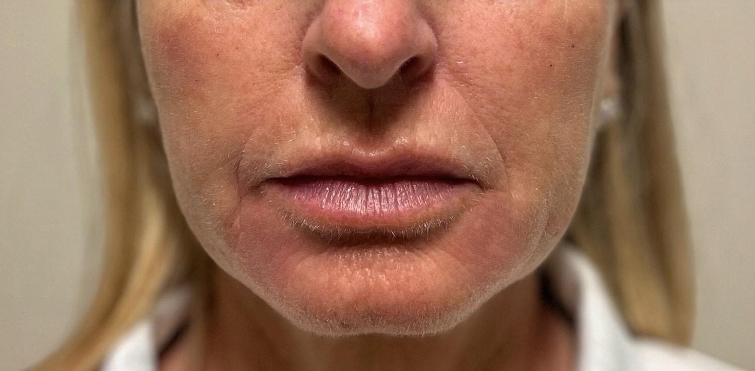Lower Face Before & After
