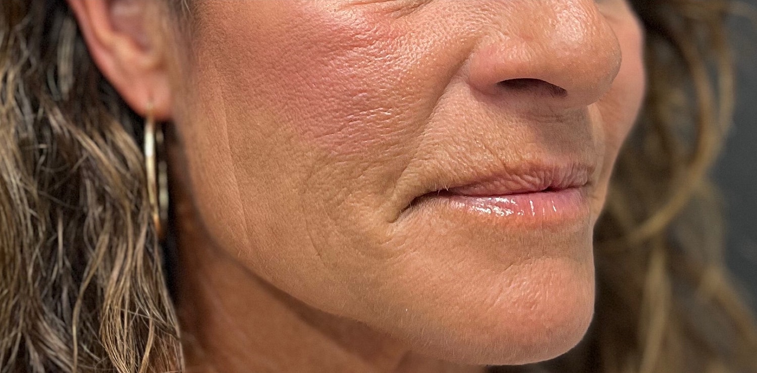 Lower Face Before & After