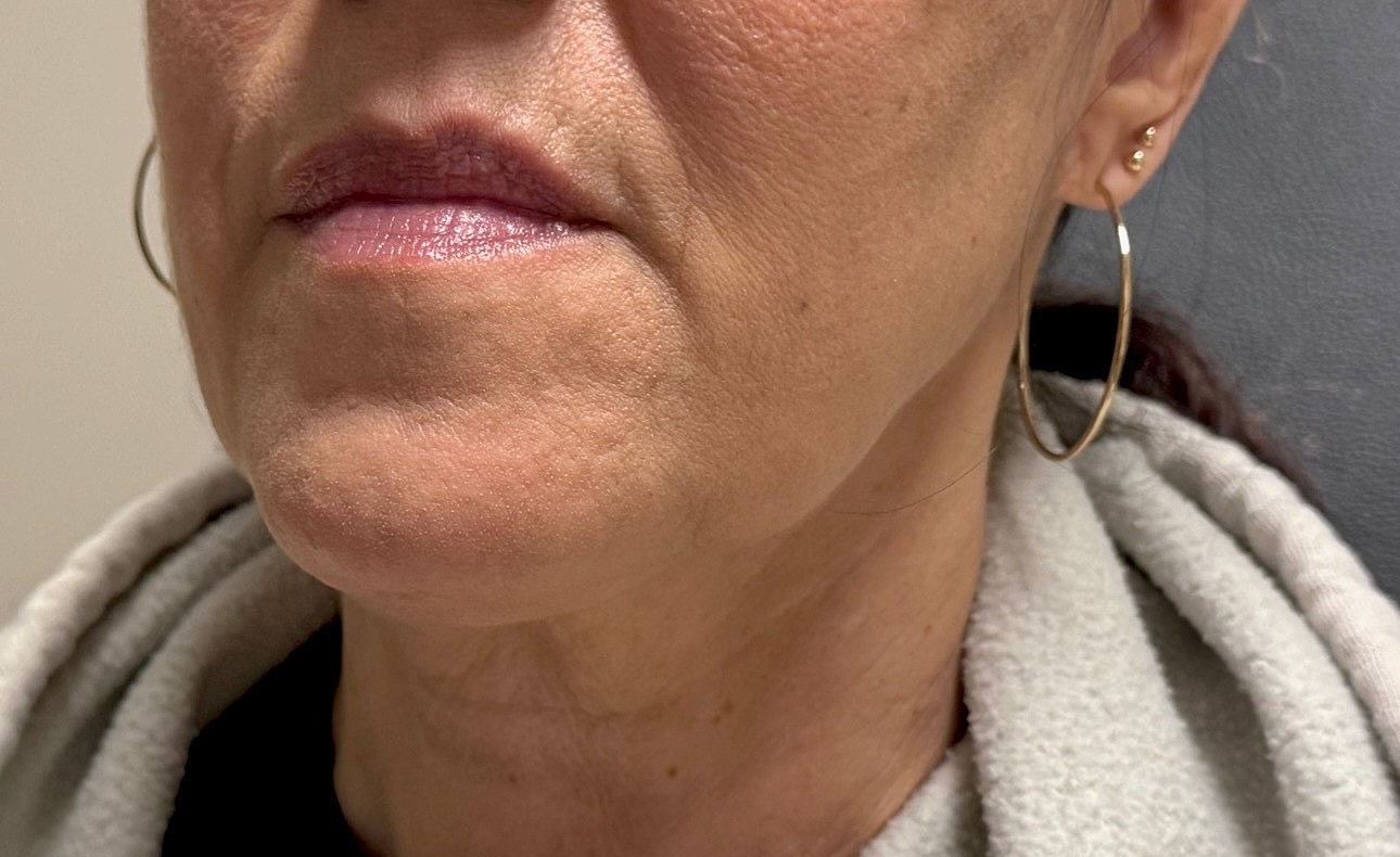 Lower Face Before & After