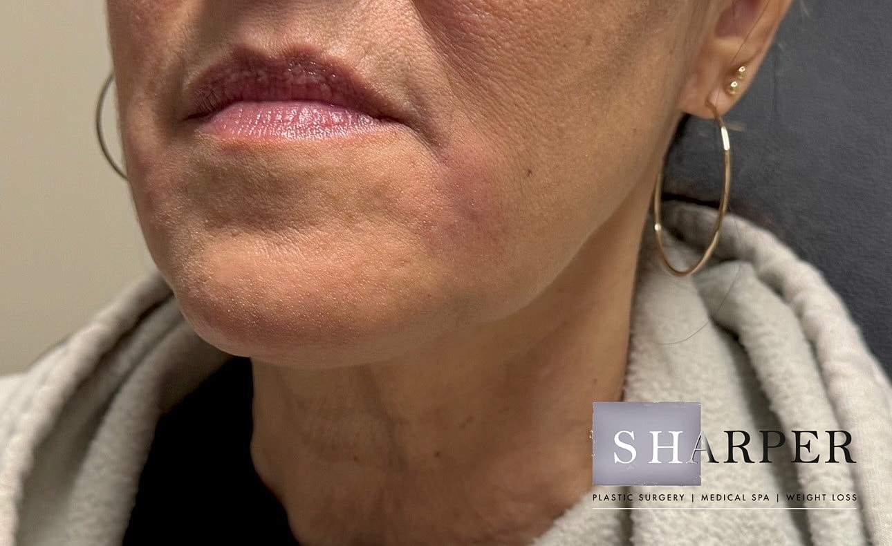 Lower Face Before & After