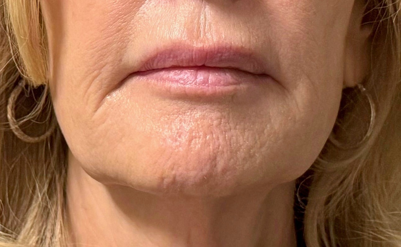 Lower Face Before & After