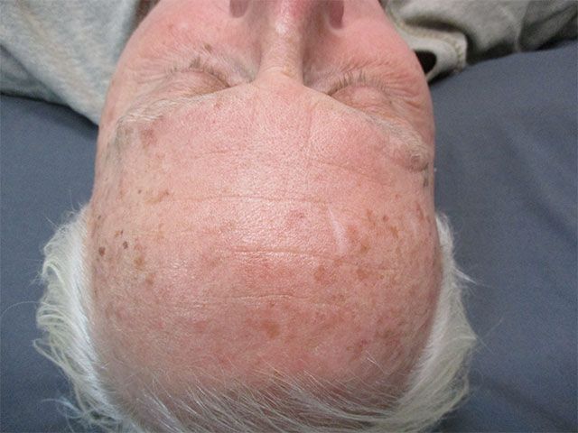 Sun Damage Before & After