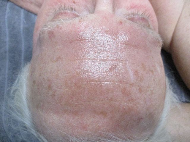 Sun Damage Before & After