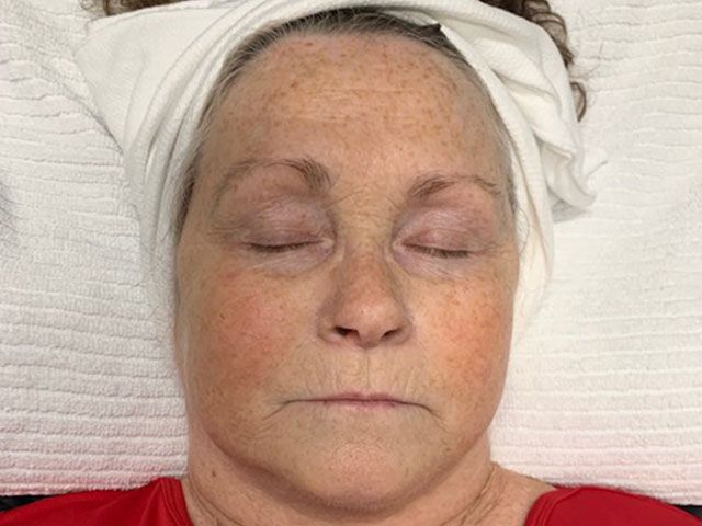 Sun Damage Before & After