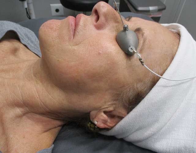 Sun Damage Before & After