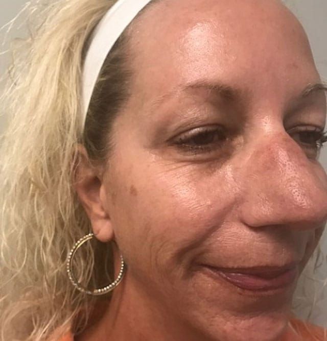 Sun Damage Before & After