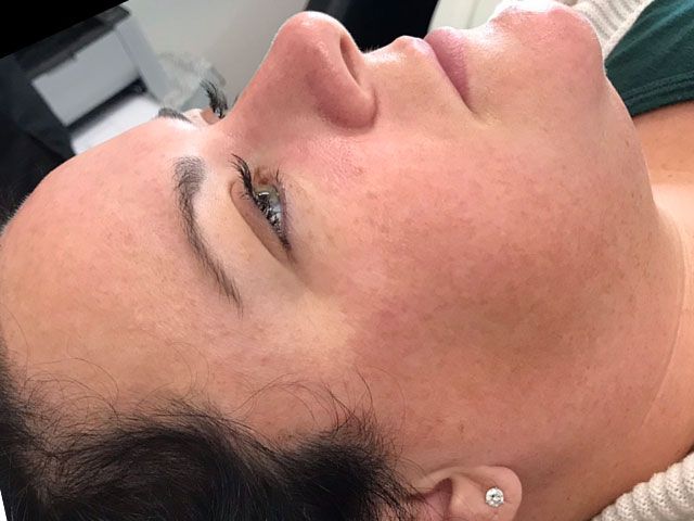 Sun Damage Before & After