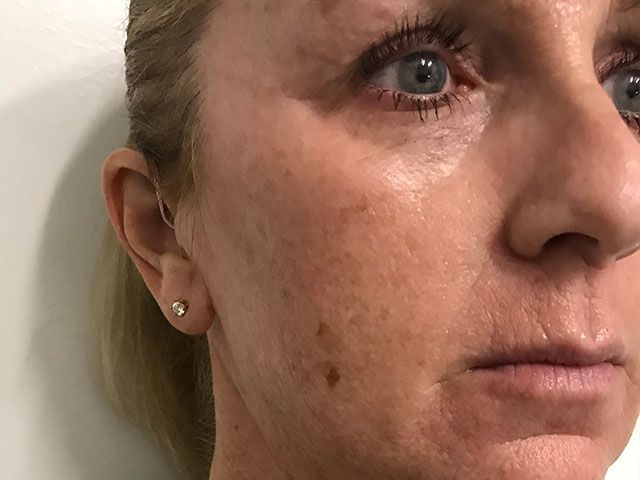 Sun Damage Before & After