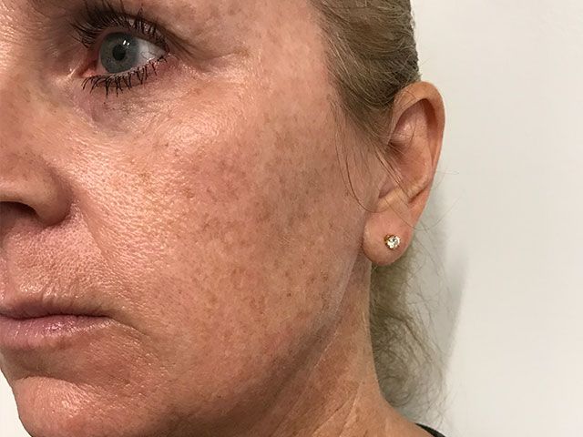 Sun Damage Before & After