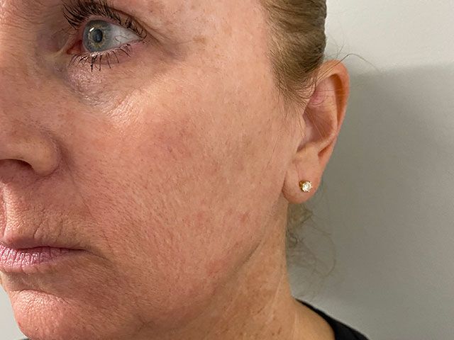 Sun Damage Before & After