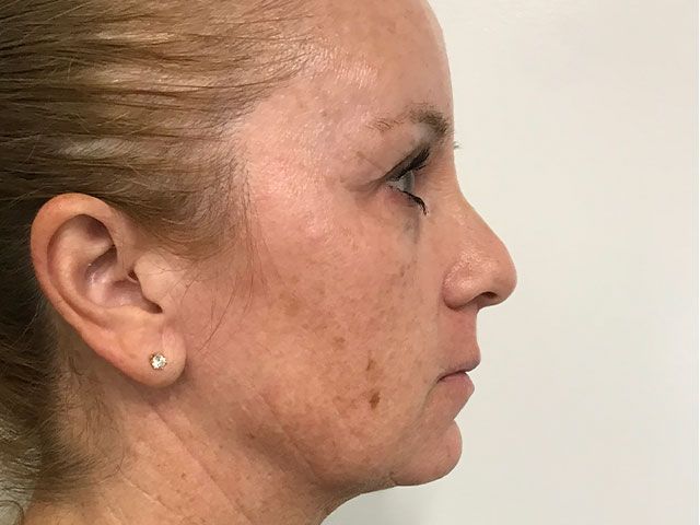 Sun Damage Before & After