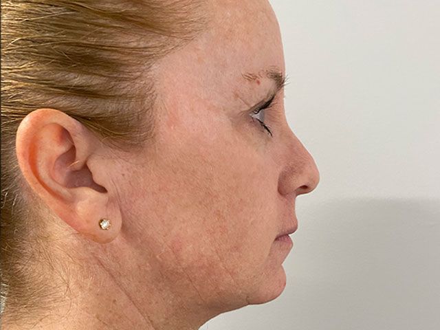 Sun Damage Before & After