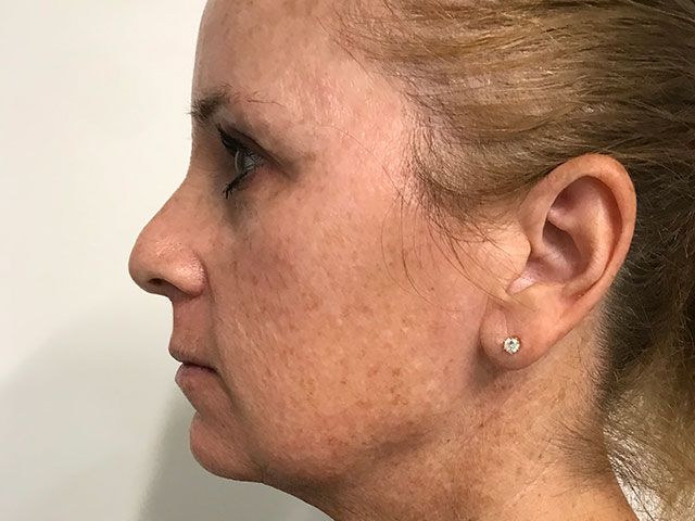 Sun Damage Before & After