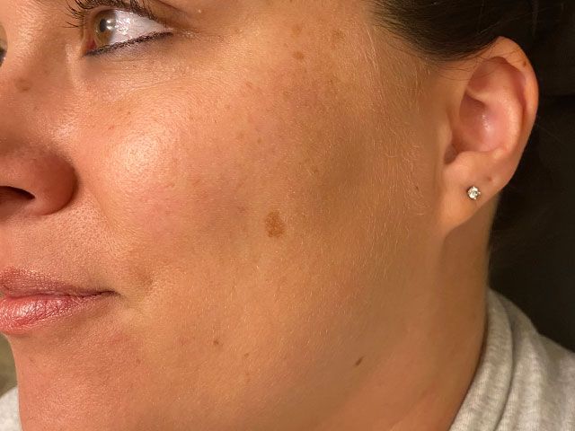 Sun Damage Before & After