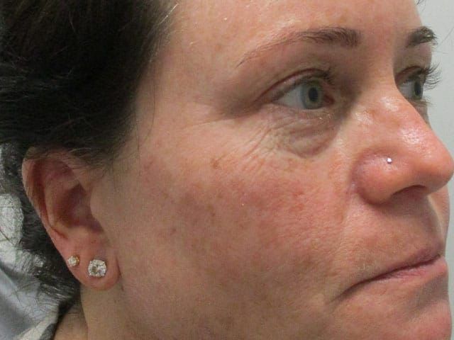 Sun Damage Before & After