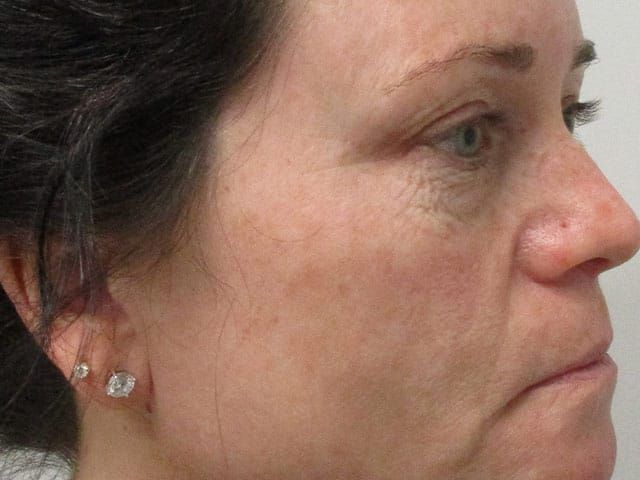 Sun Damage Before & After