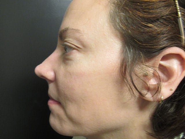 Sun Damage Before & After