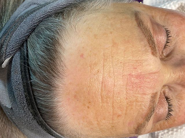 Sun Damage Before & After