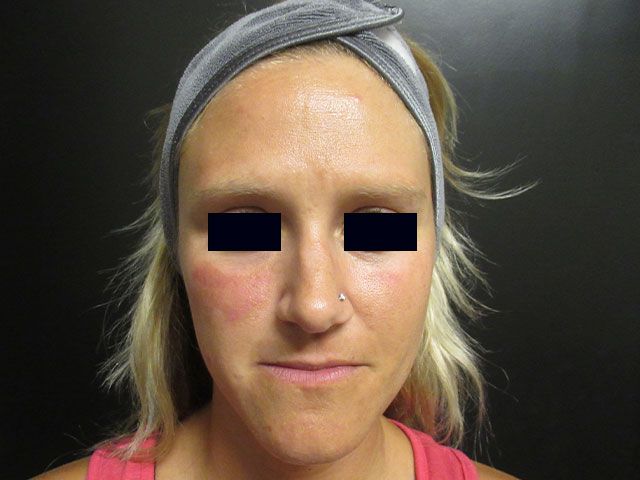 Sun Damage Before & After