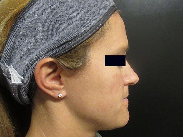 Sun Damage Before & After