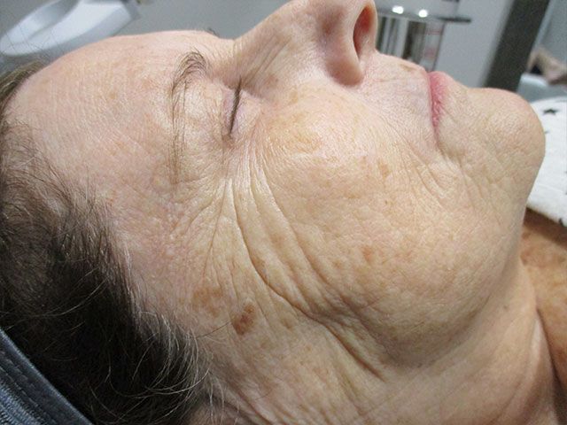 Sun Damage Before & After