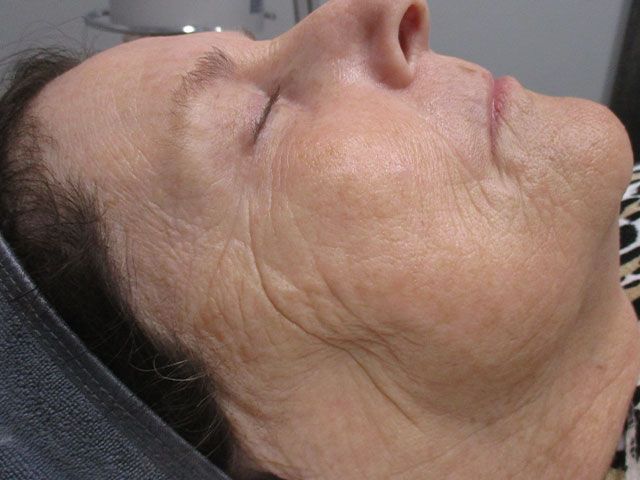 Sun Damage Before & After