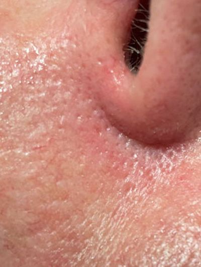 Sun Damage Before & After