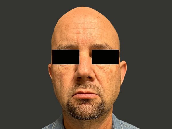 Sun Damage Before & After