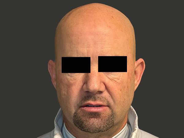 Sun Damage Before & After