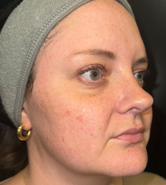 Sun Damage Before & After