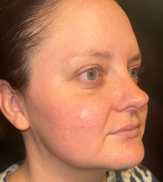 Sun Damage Before & After