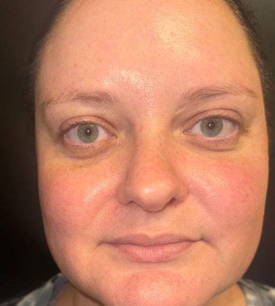 Sun Damage Before & After