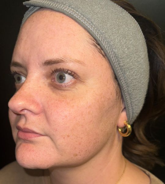 Sun Damage Before & After