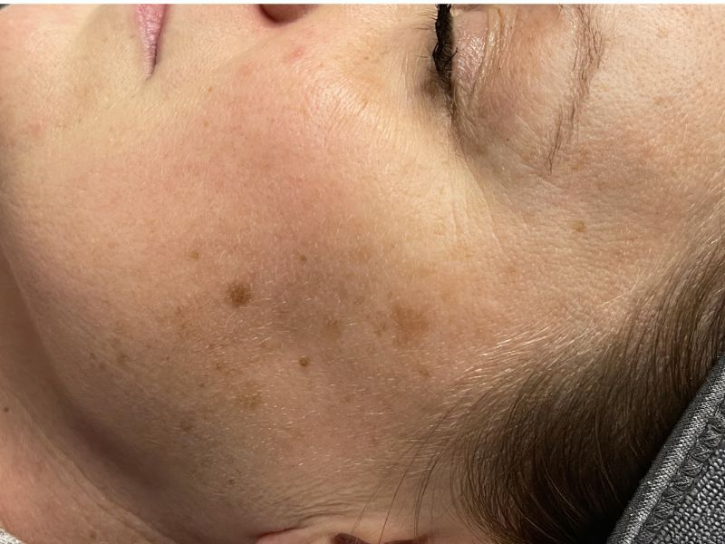 Sun Damage Before & After