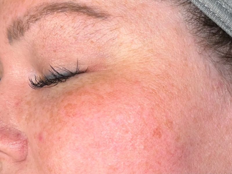 Sun Damage Before & After