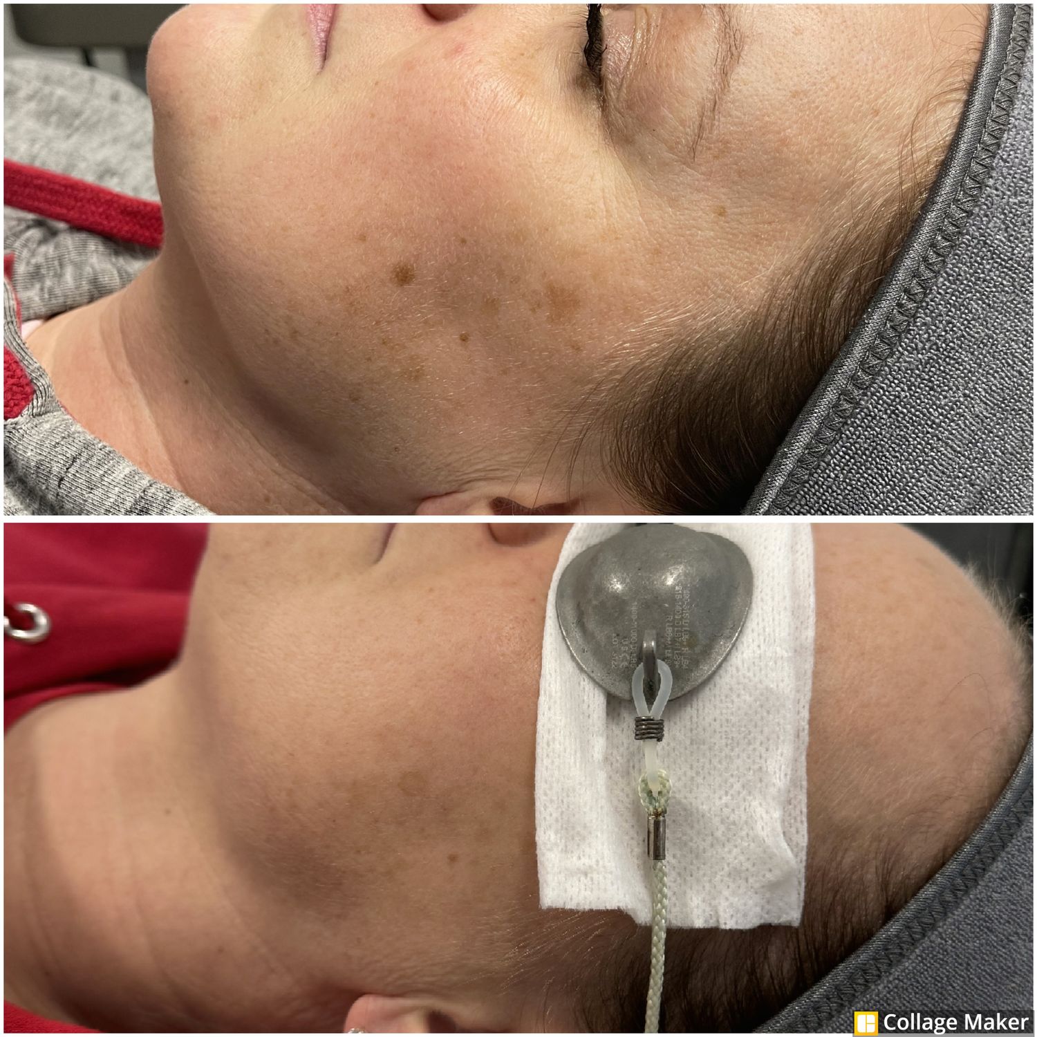 Sun Damage Before & After