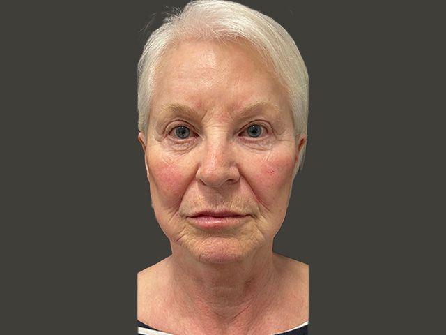 Liquid Facelift Before & After