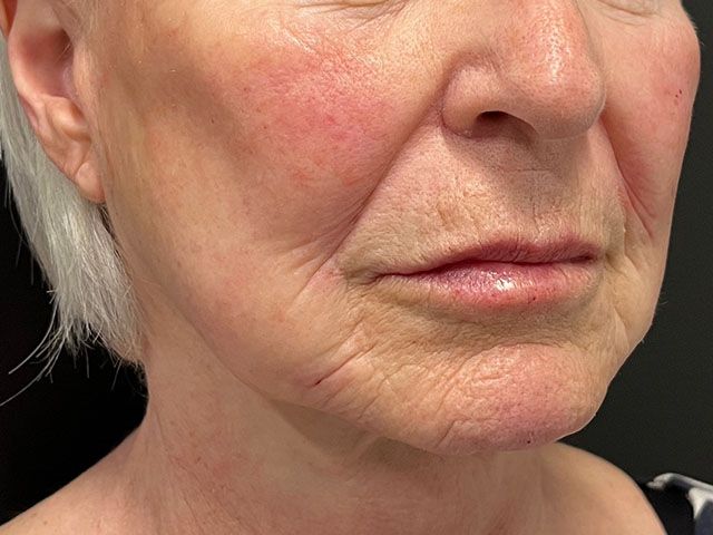 Liquid Facelift Before & After