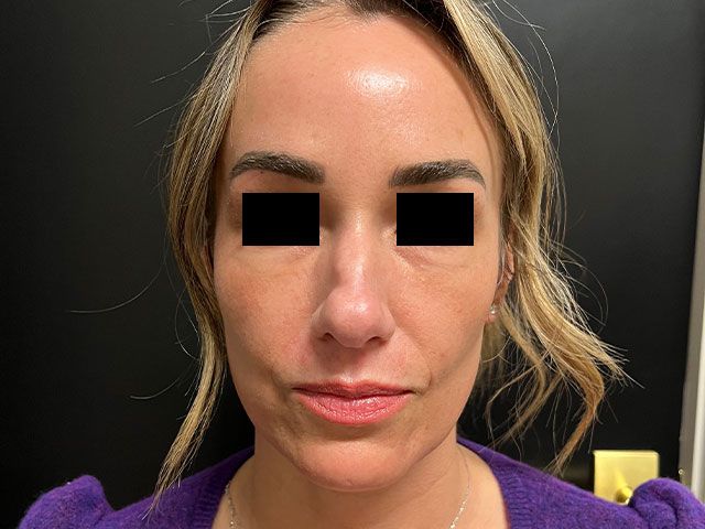 Liquid Facelift Before & After