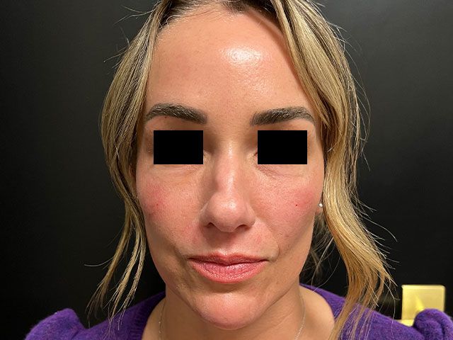 Liquid Facelift Before & After