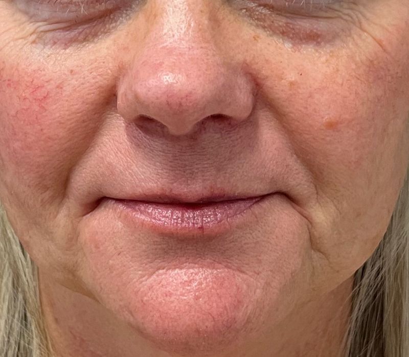Liquid Facelift Before & After