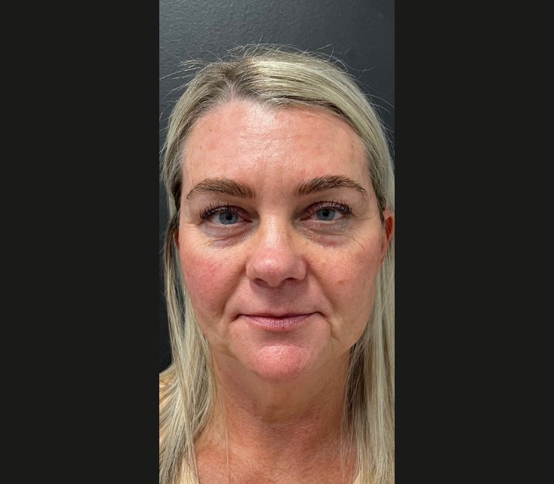 Liquid Facelift Before & After