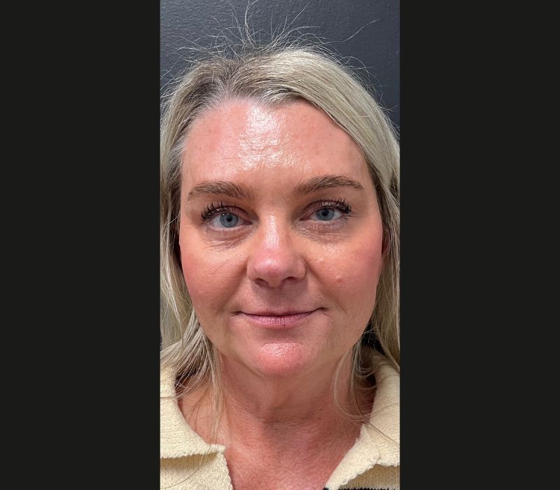 Liquid Facelift Before & After