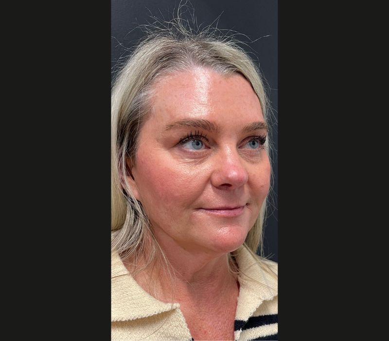 Liquid Facelift Before & After