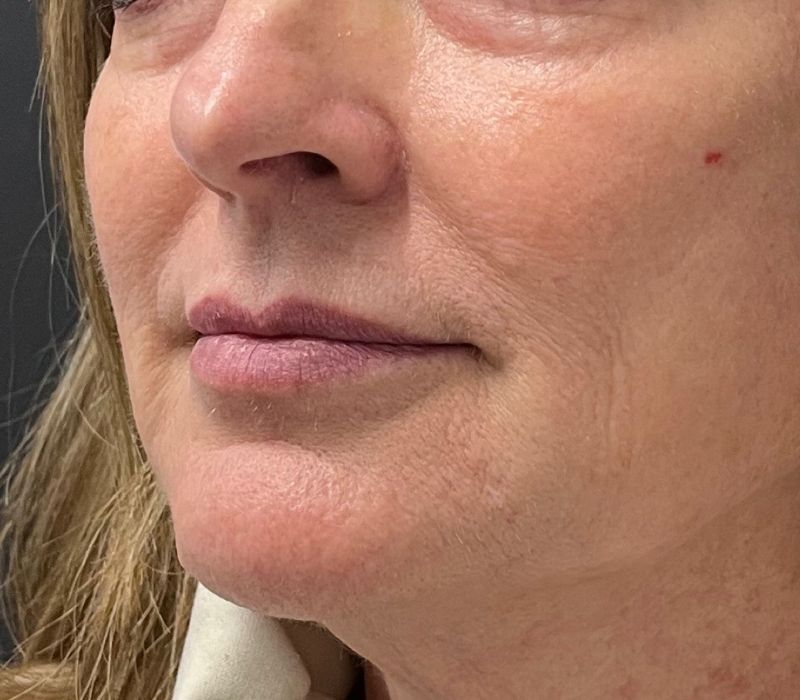 Liquid Facelift Before & After